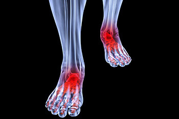 Arthritic foot and ankle care treatment, foot arthritis treatment in the Clark County, NV: Las Vegas (North Las Vegas, Spring Valley, Sunrise Manor, Paradise, Enterprise, Henderson, Whitney, Winchester, Summerlin South) areas