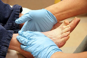 Diabetic foot treatment and care, Diabetic Ulcers Treatment & Management in the Las Vegas, NV 89128 area