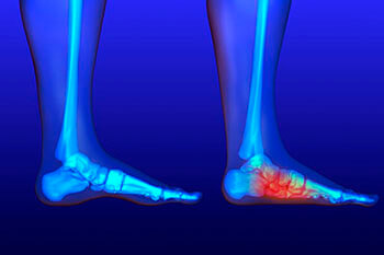 Flat feet and Fallen Arches treatment, Flatfoot Deformity Treatment in the Las Vegas, NV 89128 area