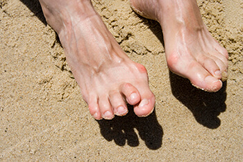 Hammertoes & Mallet Toes treatment in the Las Vegas, NV 89128 area