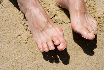 Hammertoes & Mallet Toes treatment in the Clark County, NV: Las Vegas (North Las Vegas, Spring Valley, Sunrise Manor, Paradise, Enterprise, Henderson, Whitney, Winchester, Summerlin South) areas