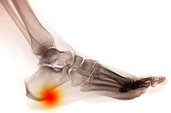 Heel spurs treatment in the Las Vegas, NV 89128 area