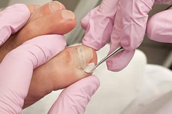 Ingrown toenails treatment in the Clark County, NV: Las Vegas (North Las Vegas, Spring Valley, Sunrise Manor, Paradise, Enterprise, Henderson, Whitney, Winchester, Summerlin South) areas