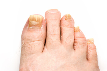 Fungal toenails diagnosis and treatment in the Clark County, NV: Las Vegas (North Las Vegas, Spring Valley, Sunrise Manor, Paradise, Enterprise, Henderson, Whitney, Winchester, Summerlin South) areas