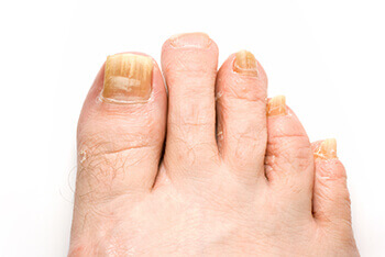 Fungal toenails diagnosis and treatment in the Clark County, NV: Las Vegas (North Las Vegas, Spring Valley, Sunrise Manor, Paradise, Enterprise, Henderson, Whitney, Winchester, Summerlin South) areas