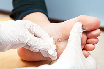 Plantar warts treatment in the Clark County, NV: Las Vegas (North Las Vegas, Spring Valley, Sunrise Manor, Paradise, Enterprise, Henderson, Whitney, Winchester, Summerlin South) areas