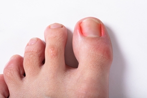 Why Do Ingrown Toenails Form?