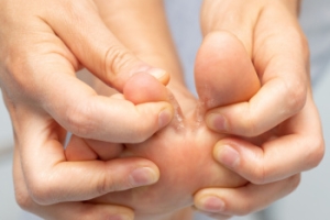 Blisters From Athlete’s Foot