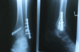 Did I Break My Ankle?