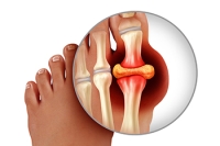 Various Ways of Testing for Gout