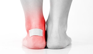 What Caused My Foot Blister?