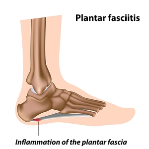 Treating Plantar Fasciitis 