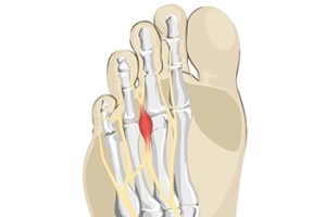 What Is Causing a Burning Sensation in the Ball of My Foot?