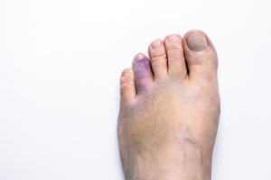 Causes and Symptoms of a Sprained Toe