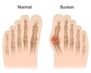 What Causes Bunions?