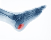 What Are Heel Spurs and How Do They Form?