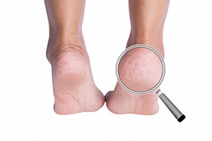 Runners and Cracked Heels